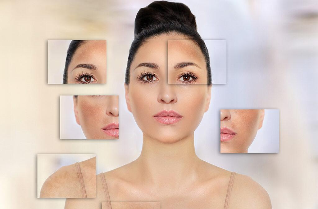 Is hyperpigmentation associated with hormones? Know the complete truth here!