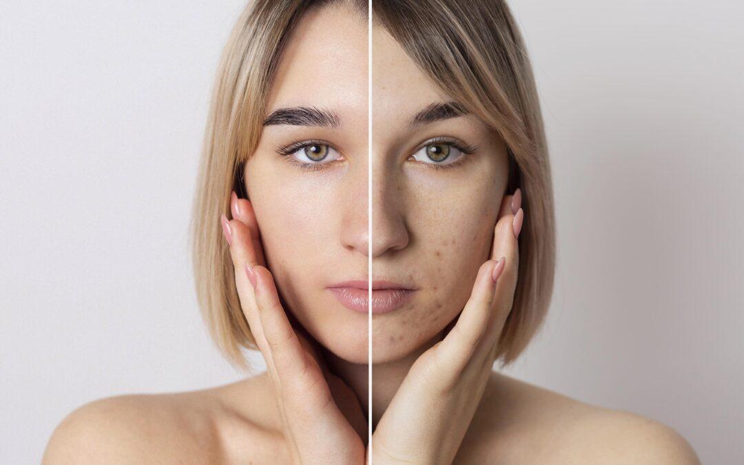 Going for hyperpigmentation treatment? Here are Seven things you must know about it!